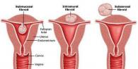 Fibroids and pregnancy - are they compatible?